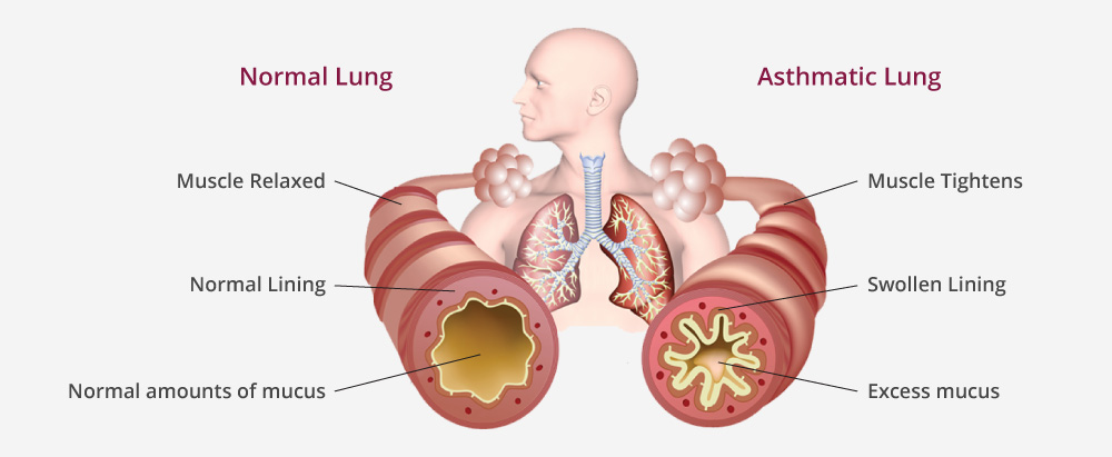 what-is-asthma-diagram-v2__1_.jpg